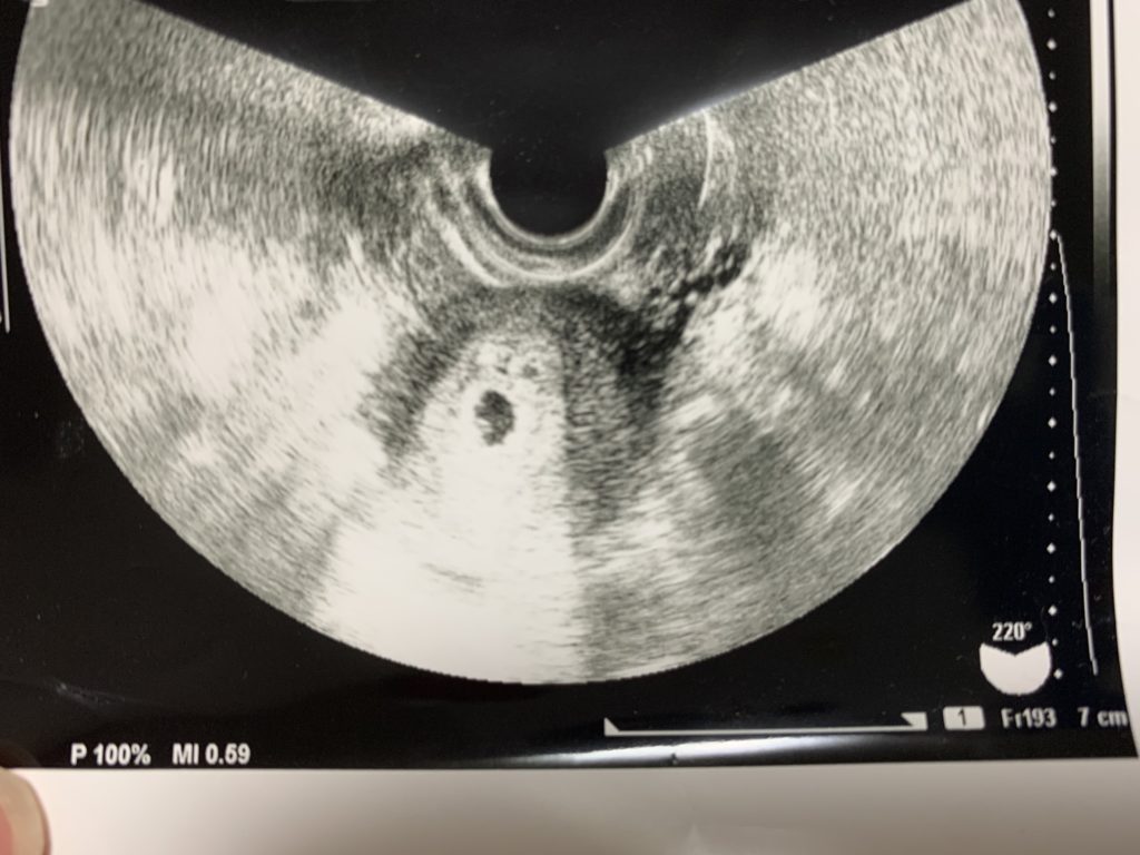 卵 管 造影 後 妊娠 した ブログ